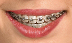 self-ligating-braces